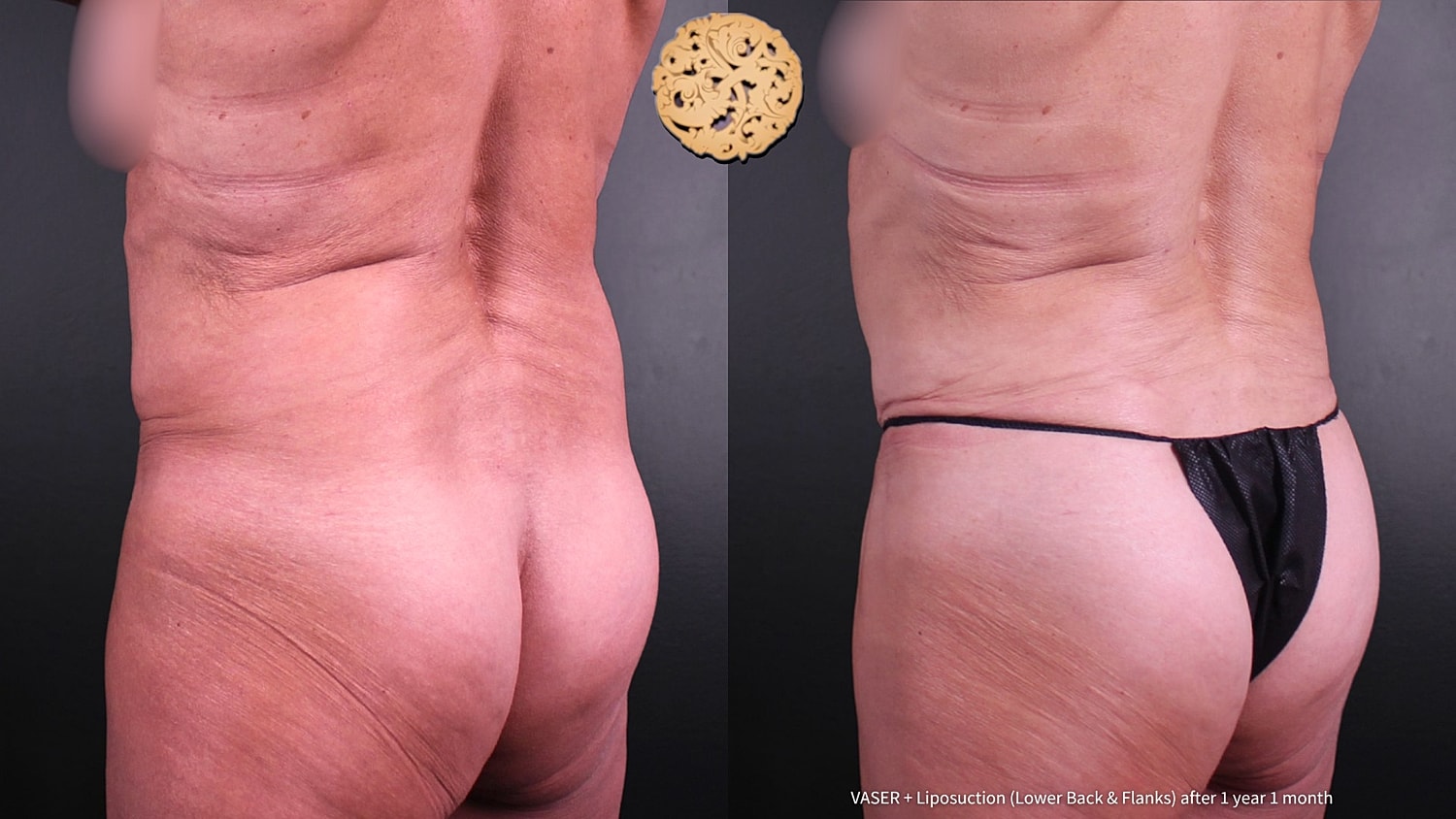 Vaser Before & After