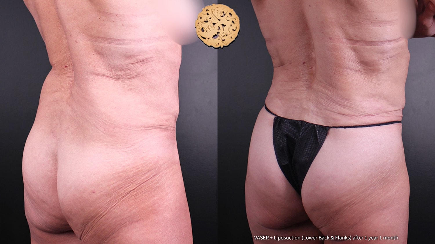 Vaser Before & After
