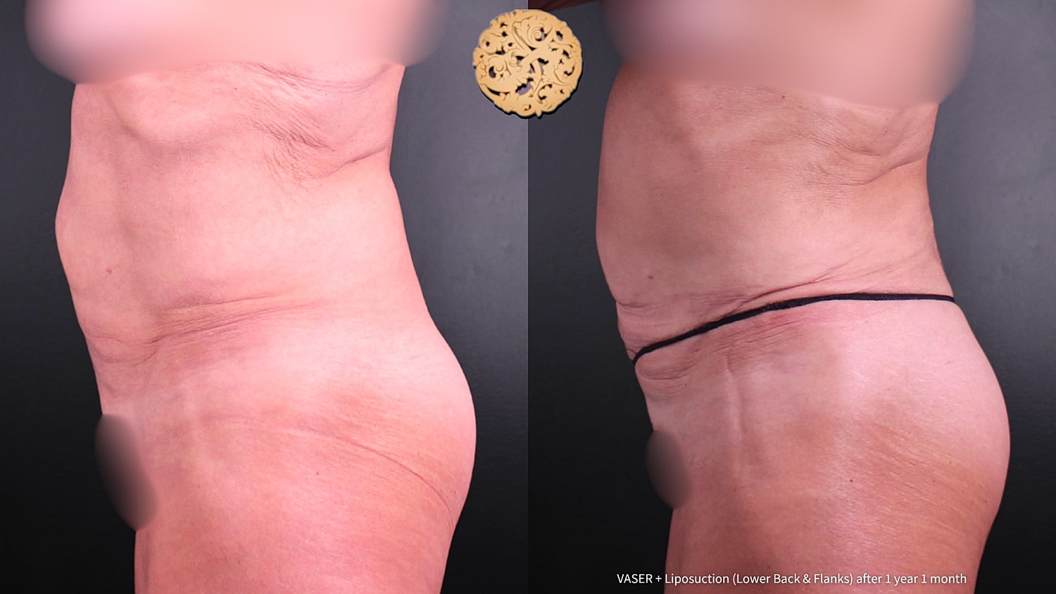 Vaser Before & After