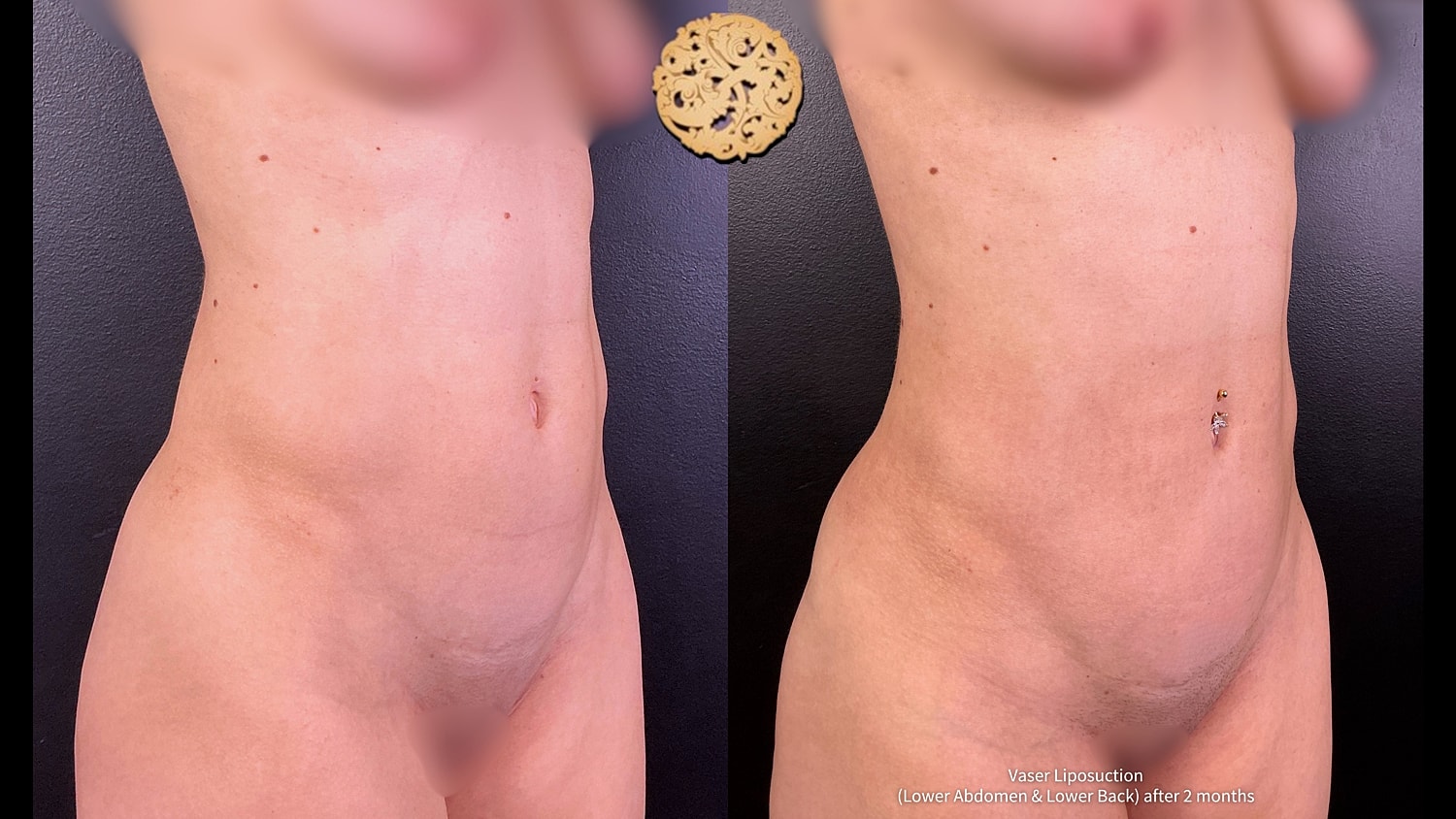 Vaser Before & After
