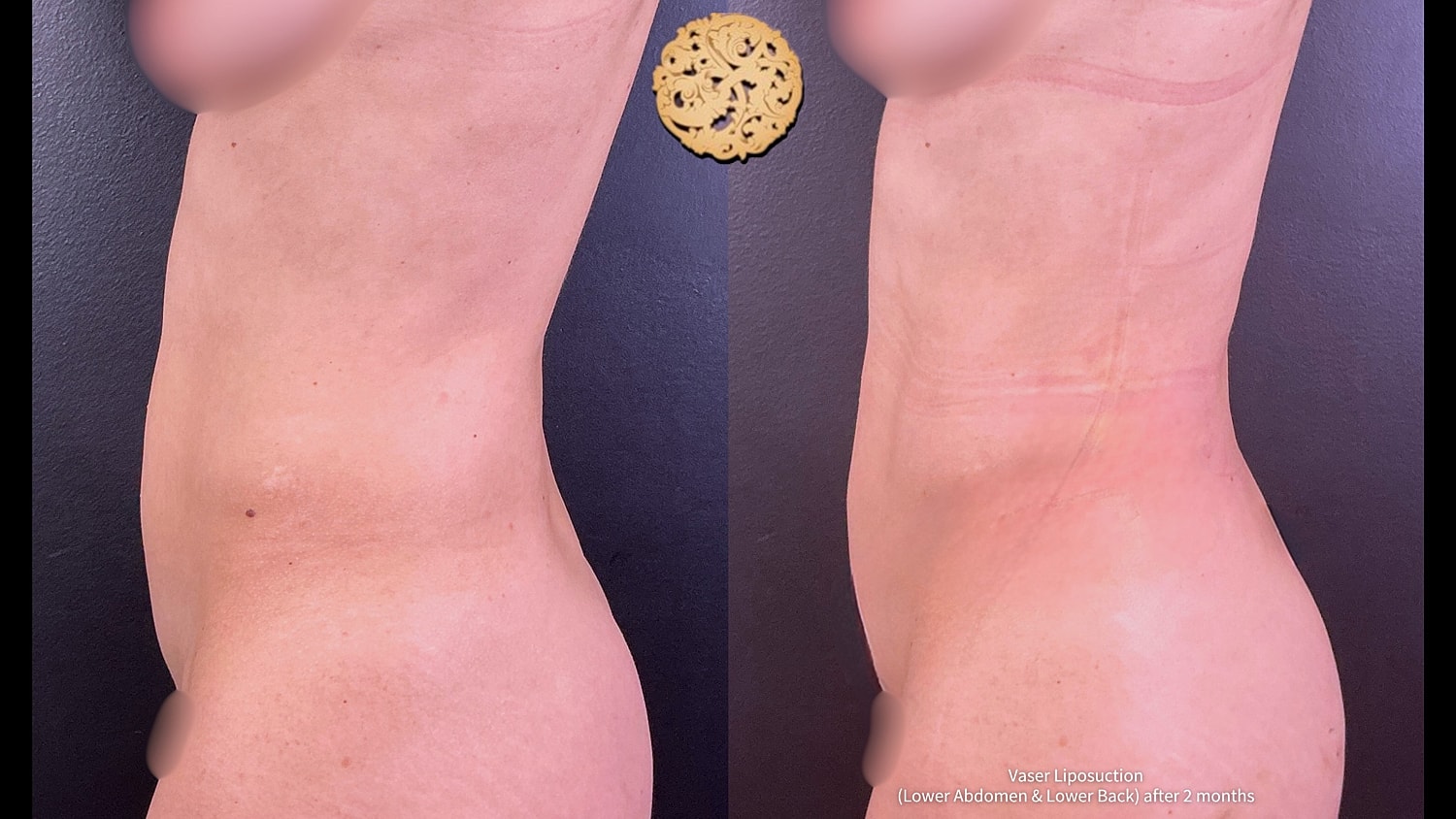 Vaser Before & After