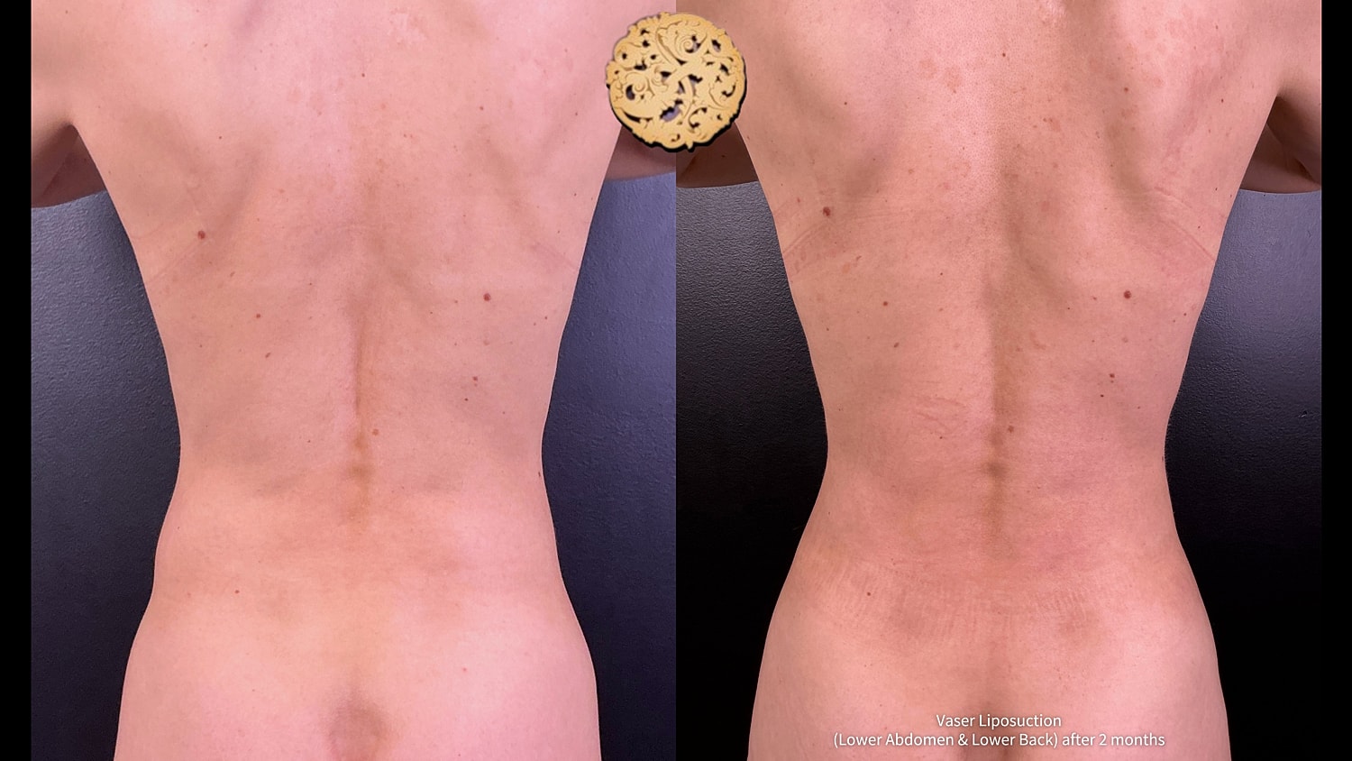 Vaser Before & After