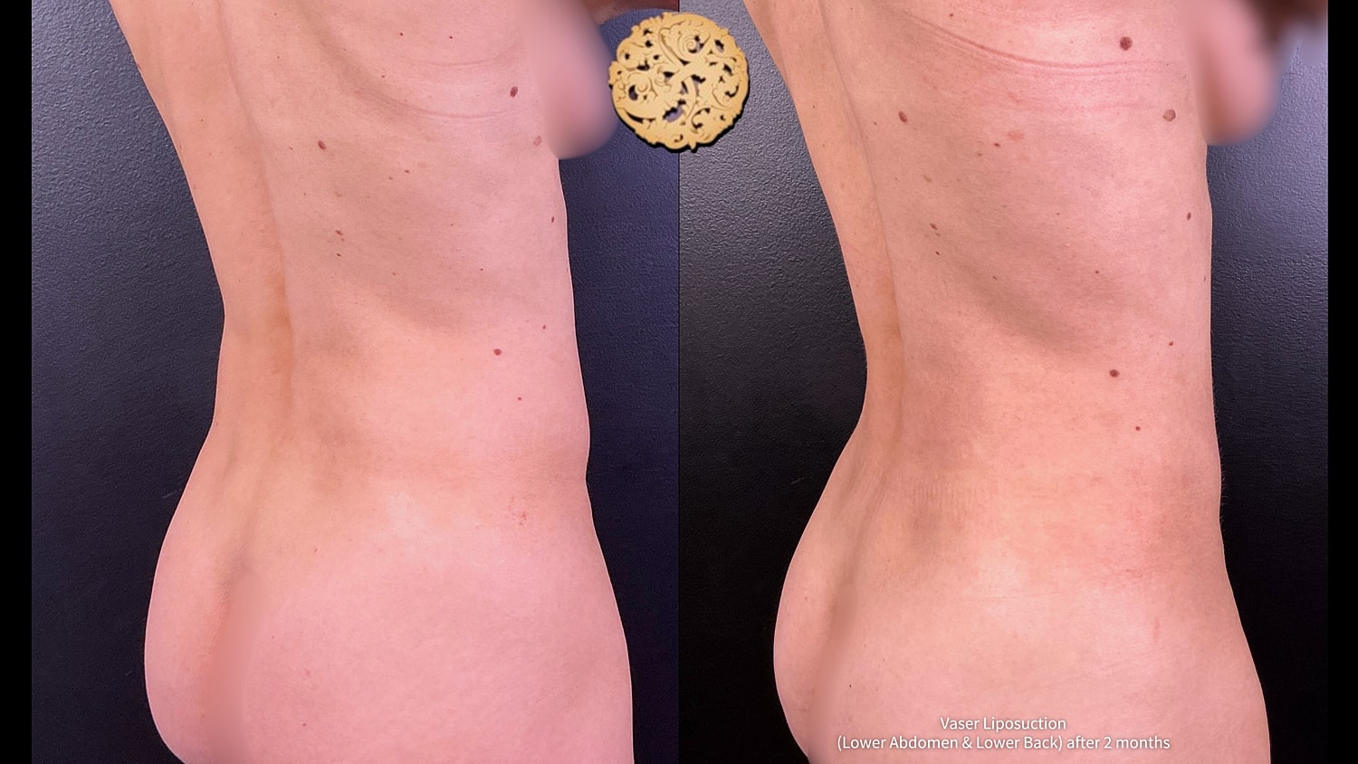 Vaser Before & After
