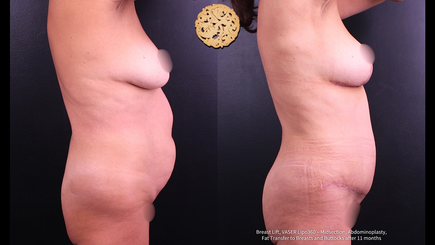 Vaser Before & After