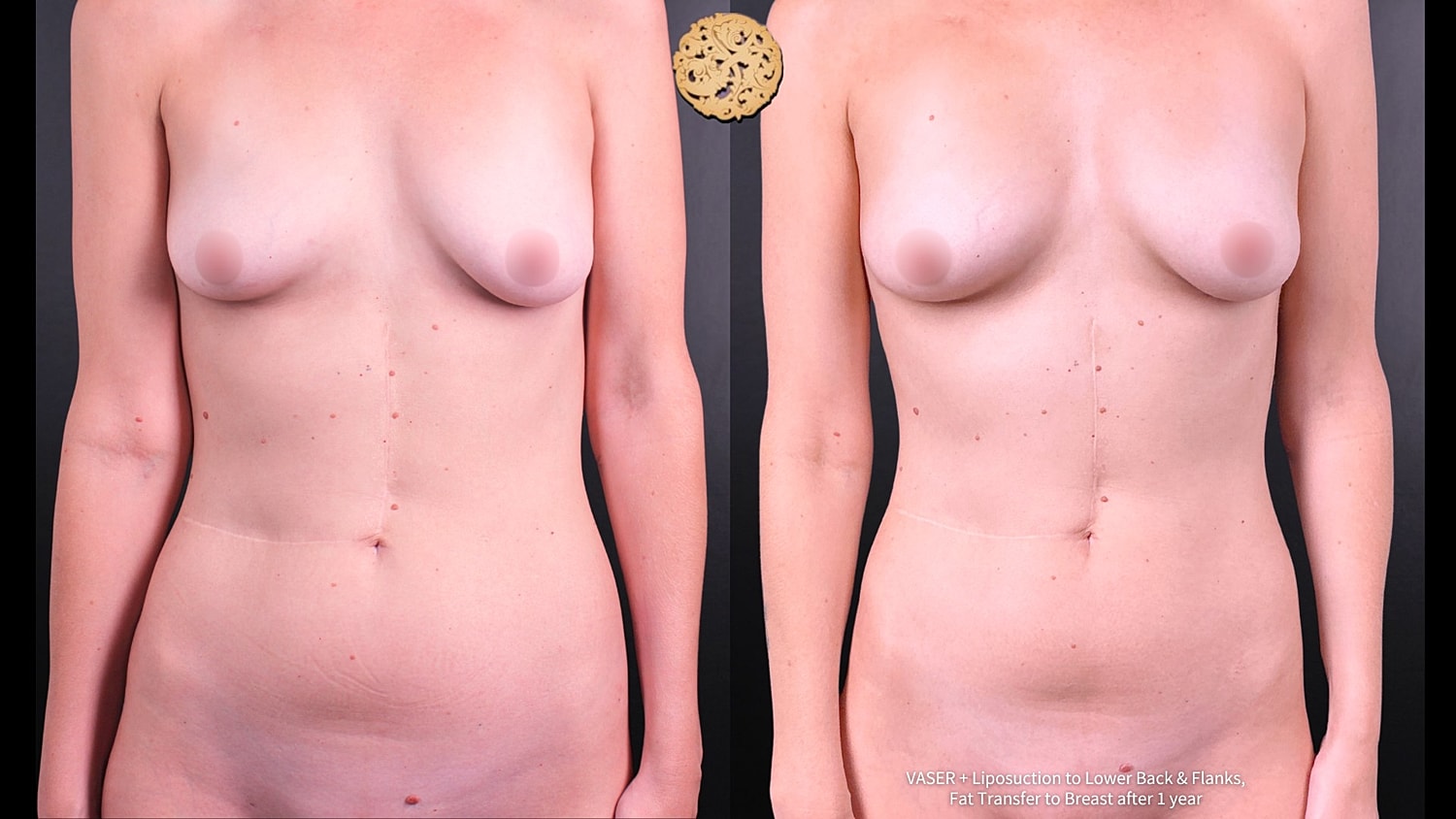 Vaser Before & After