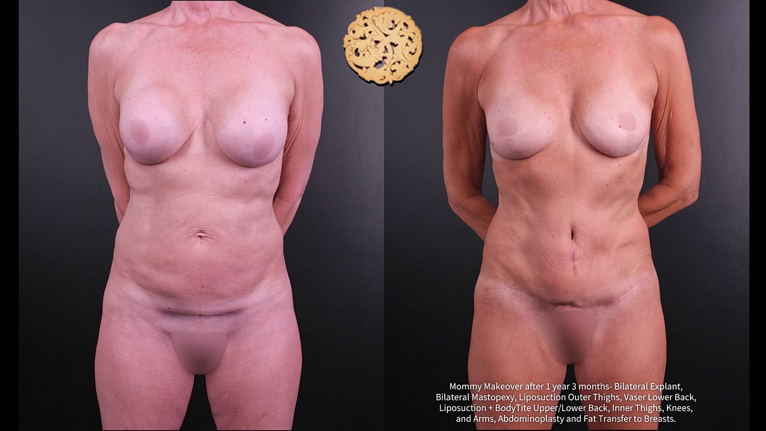 Vaser Before & After