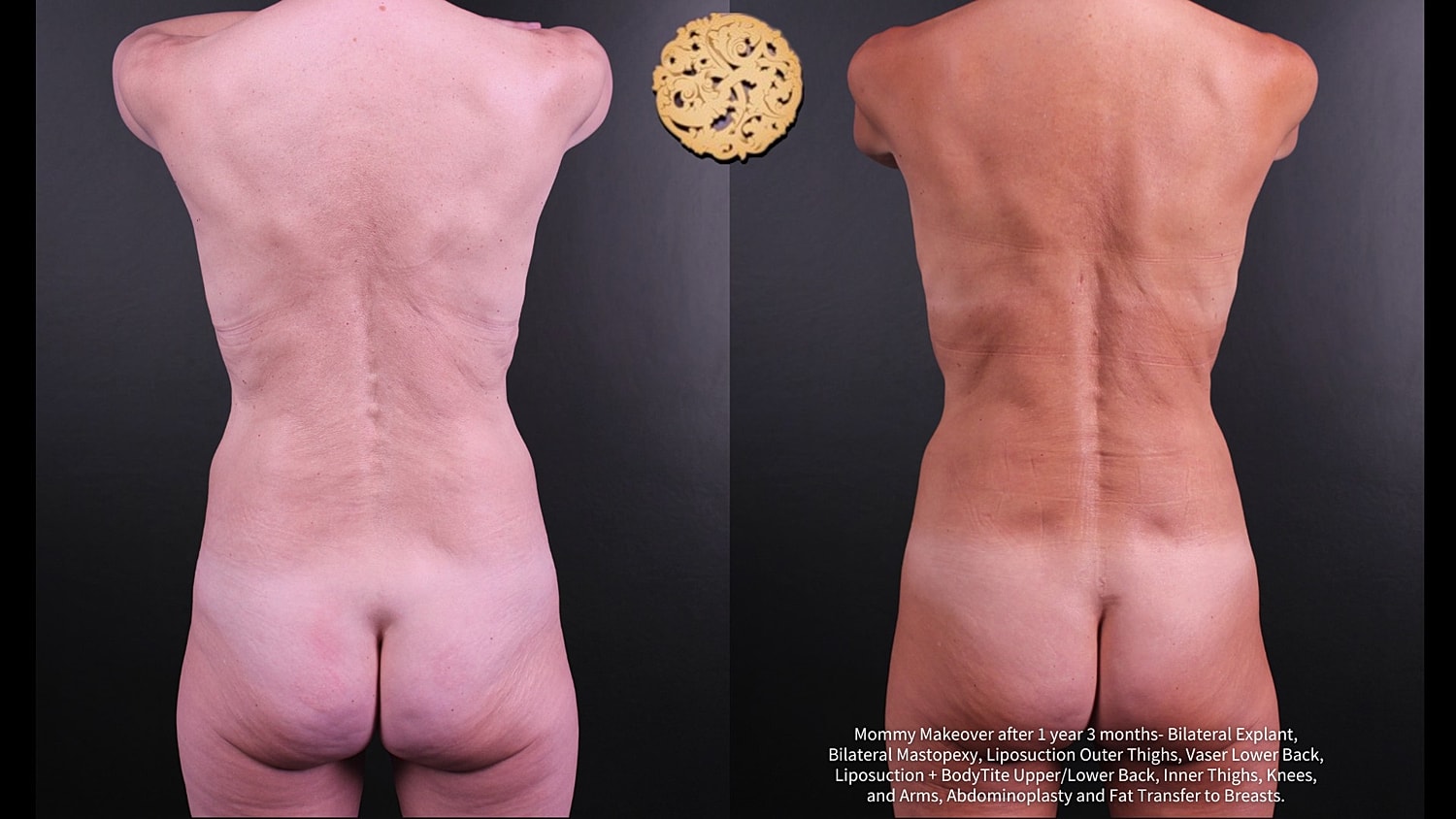 Vaser Before & After