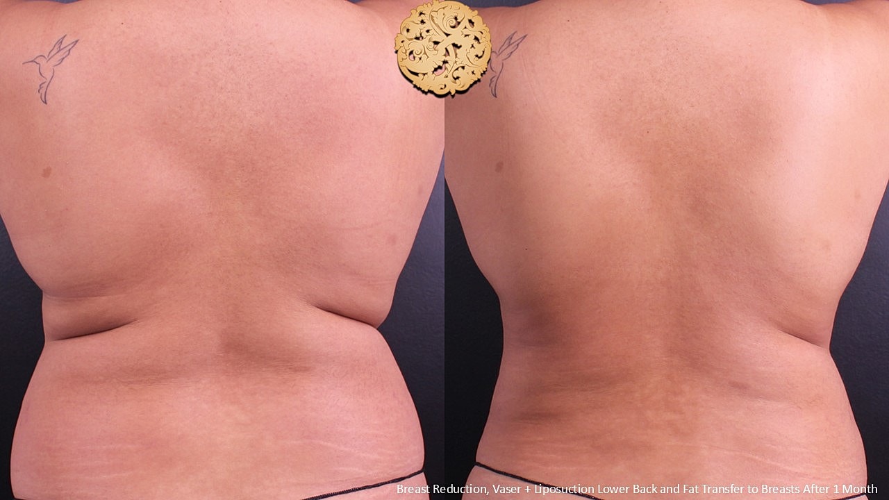 Vaser Before & After