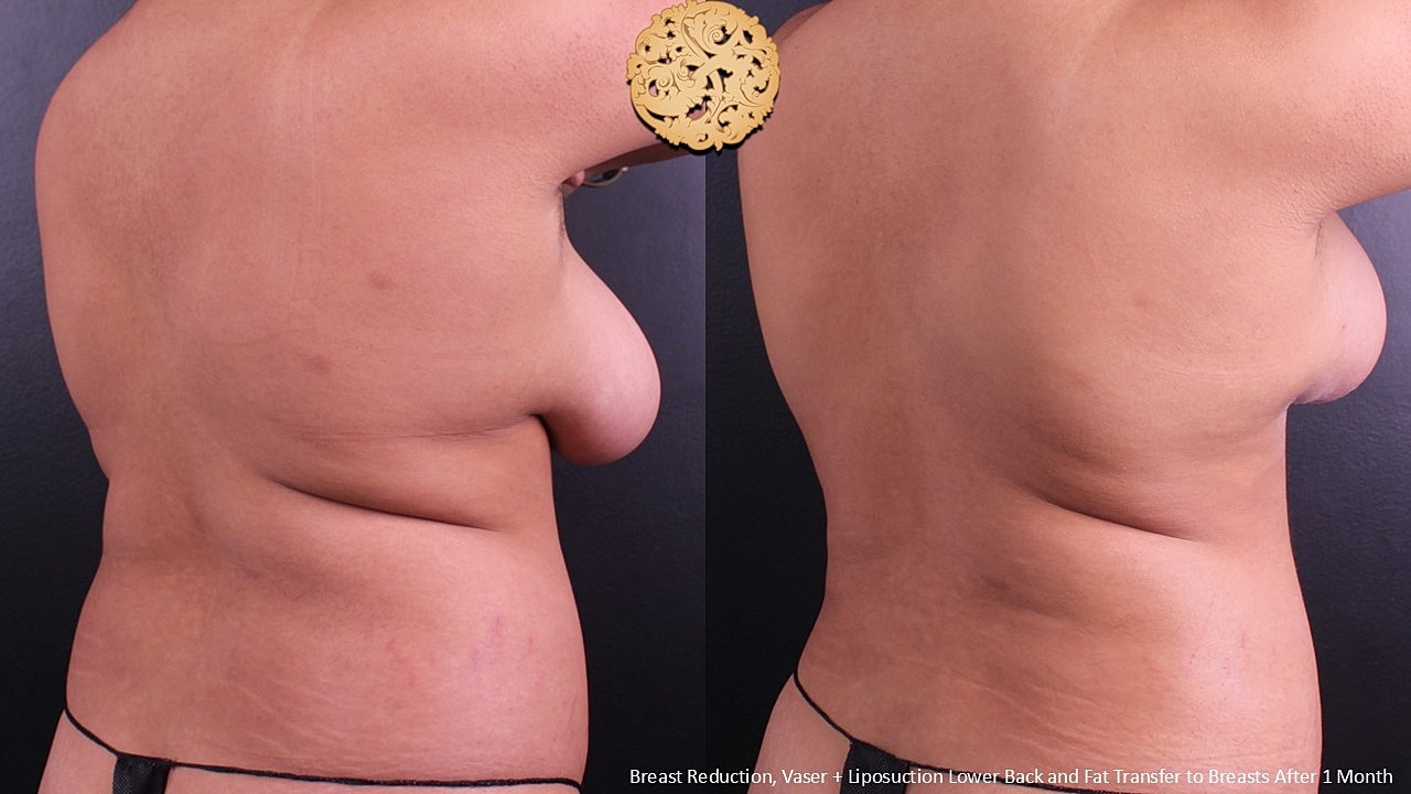 Vaser Before & After