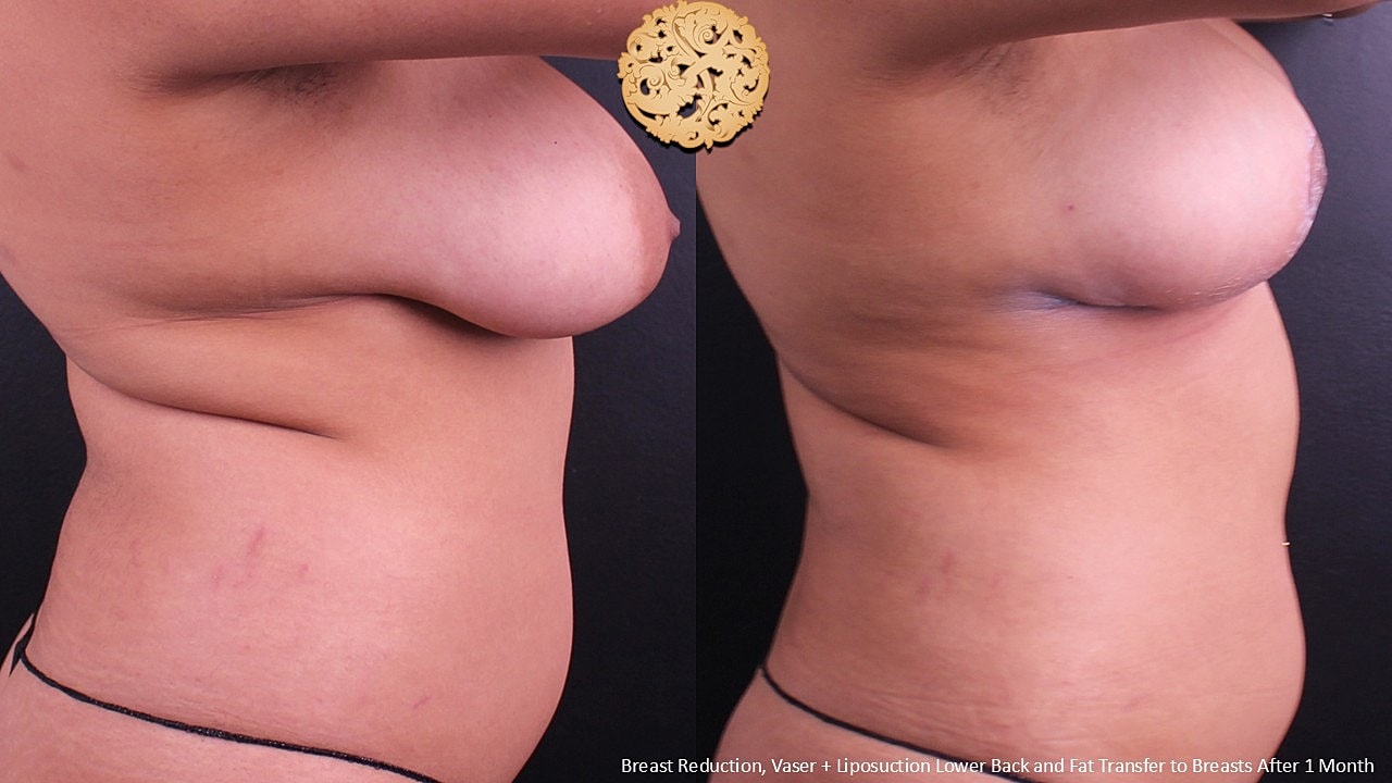 Vaser Before & After