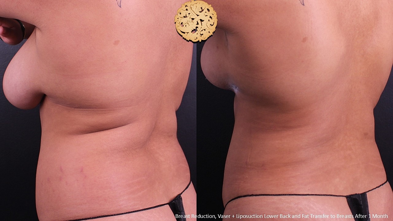 Vaser Before & After