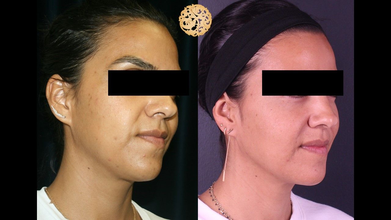 Picosure Laser Resurfacing Before & After