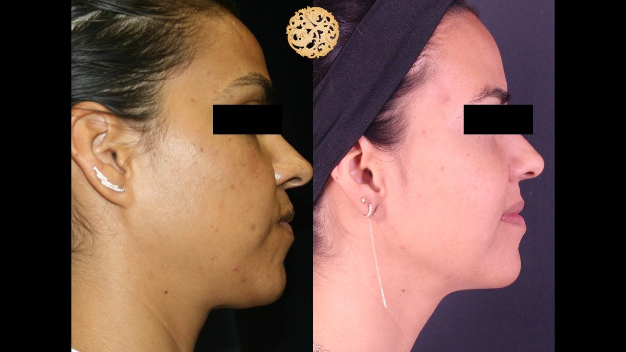 Picosure Laser Resurfacing Before & After