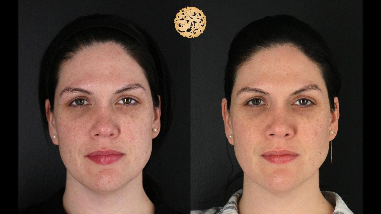 PicoSure Laser Resurfacing Before & After