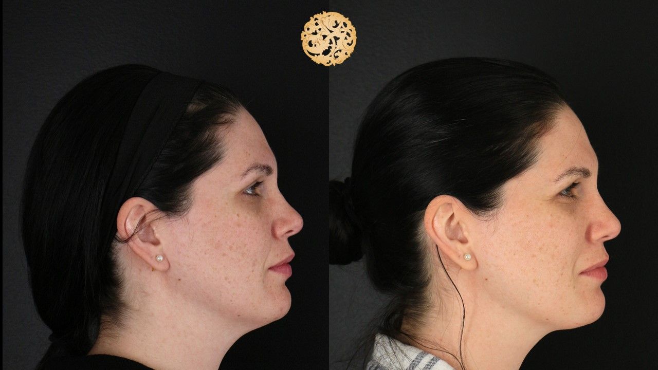 Picosure Laser Resurfacing Before & After