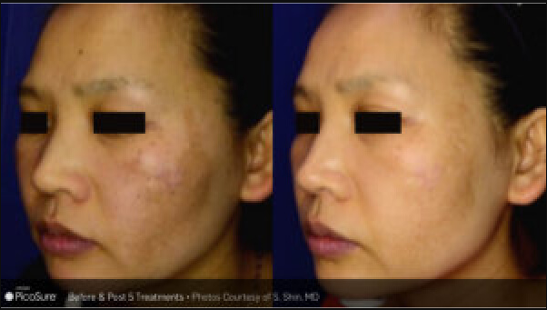PicoSure Laser Resurfacing Before & After