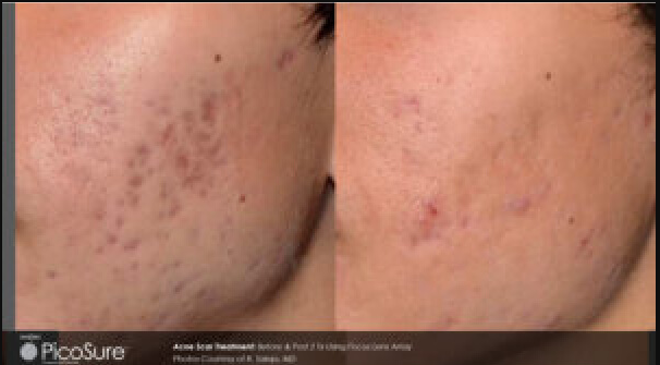 PicoSure Laser Resurfacing Before & After
