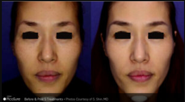 PicoSure Laser Resurfacing Before & After