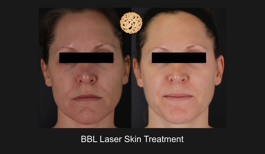 BBL Laser Before & After