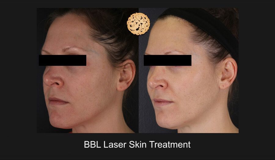 BBL Laser Before & After
