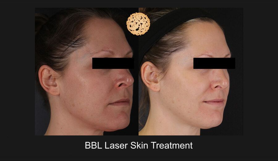 BBL Laser Before & After