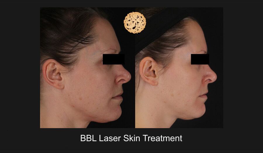 BBL Laser Before & After