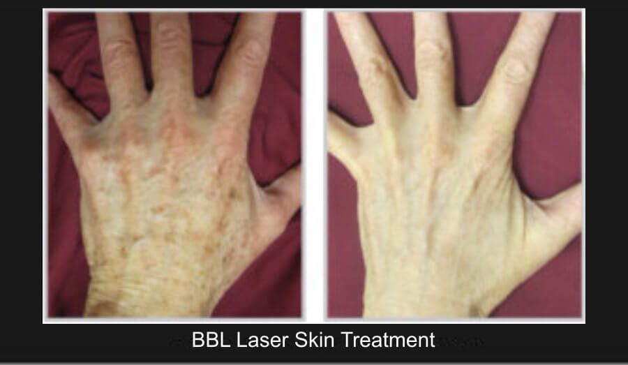BBL Laser Before & After