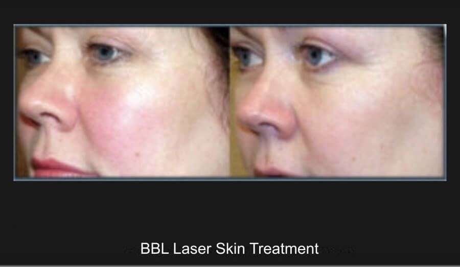 BBL Laser Before & After