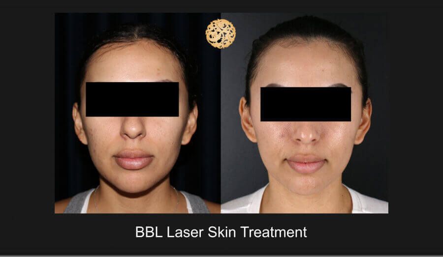BBL Laser Before & After