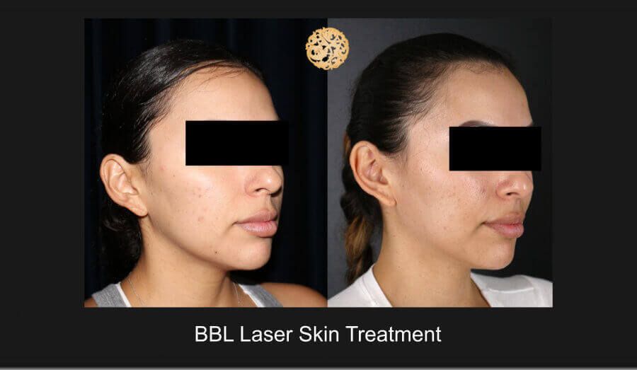 Bbl Laser Before & After