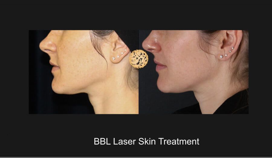 Bbl Laser Before & After