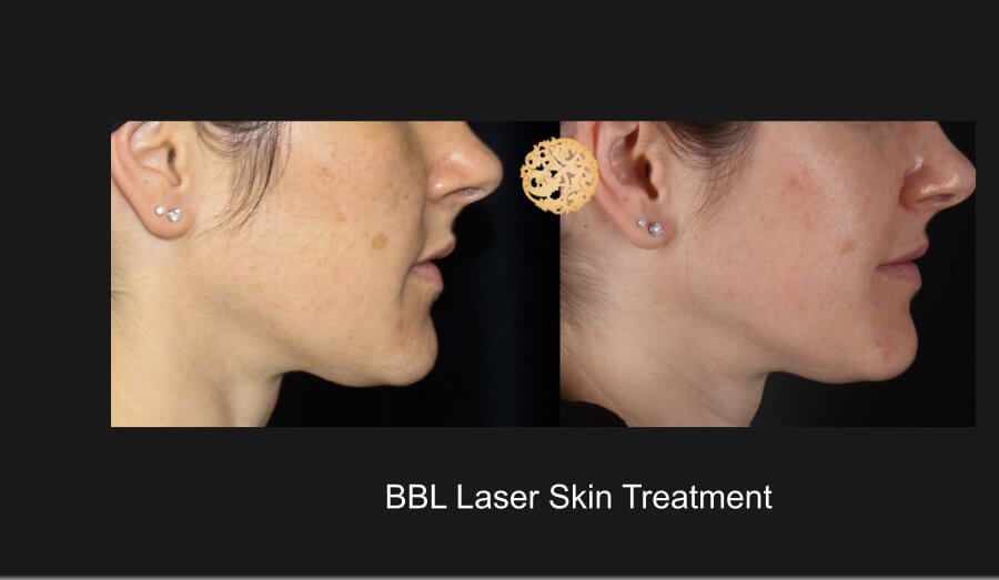 Bbl Laser Before & After
