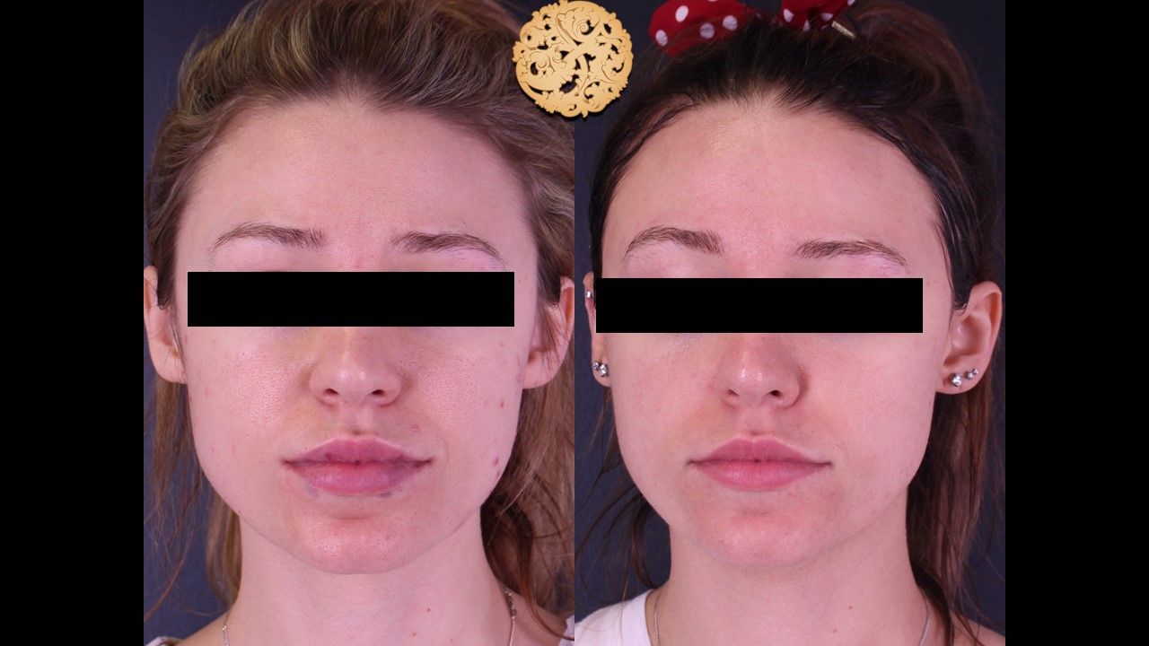 BBL Laser Before & After