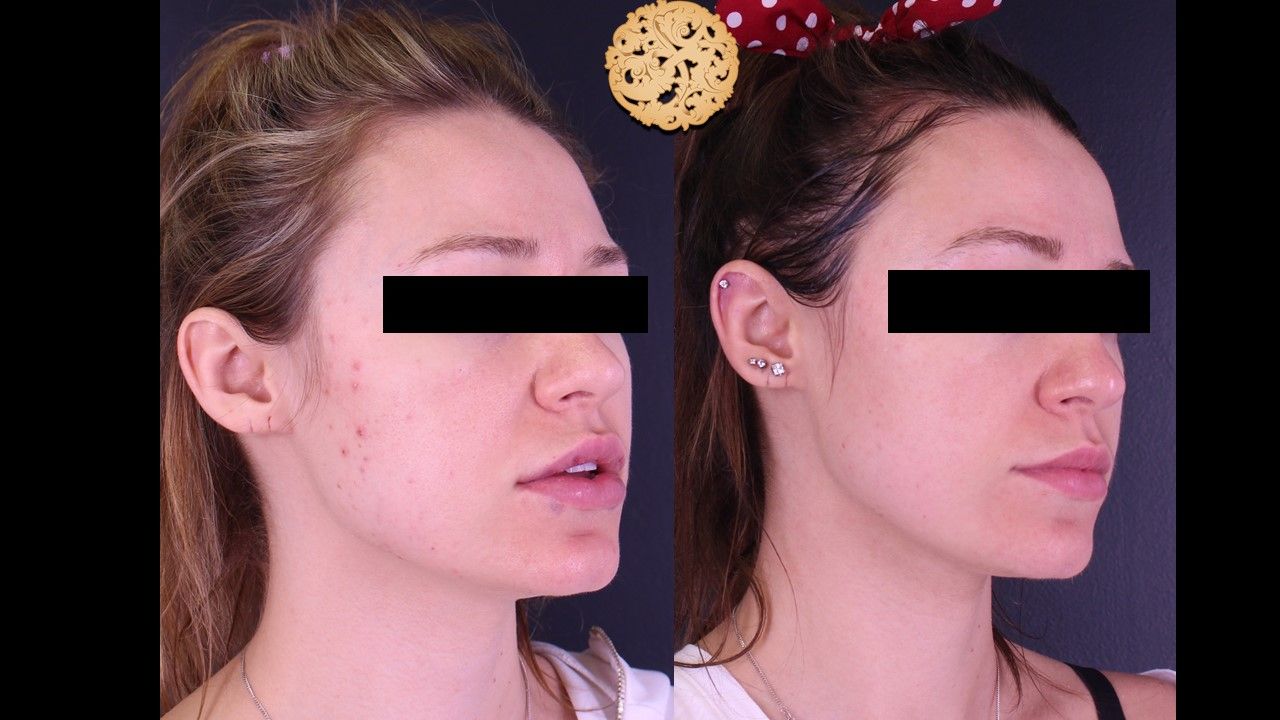 Bbl Laser Before & After