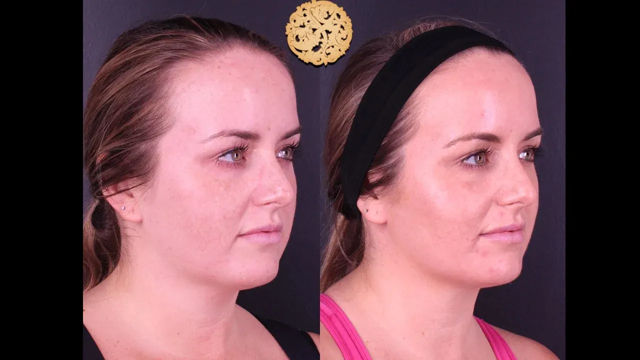 BBL Laser Before & After