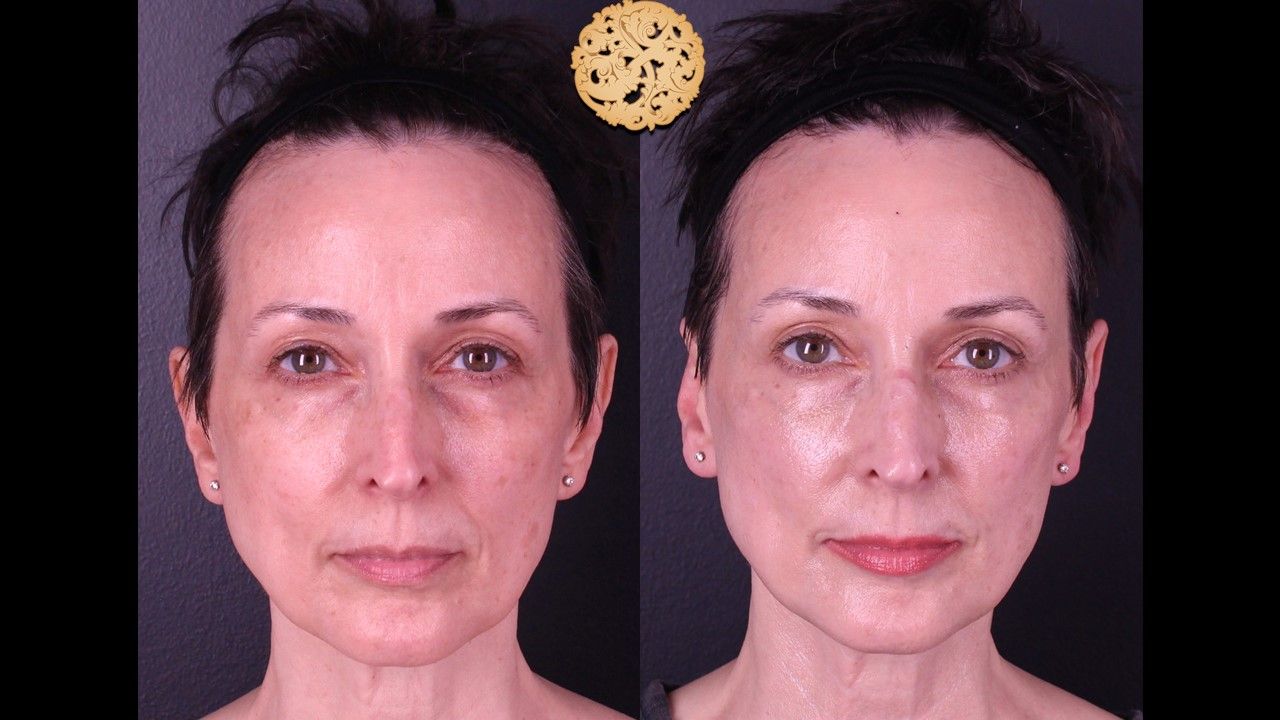 Bbl Laser Before & After