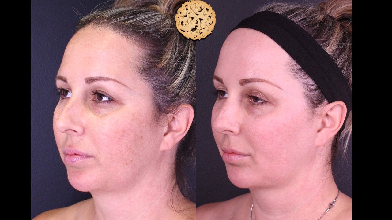 BBL Laser Before & After