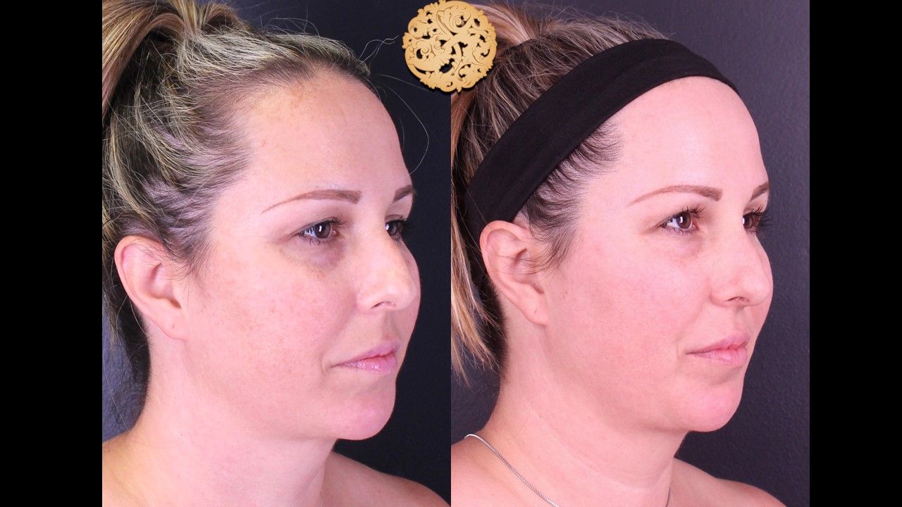 Bbl Laser Before & After