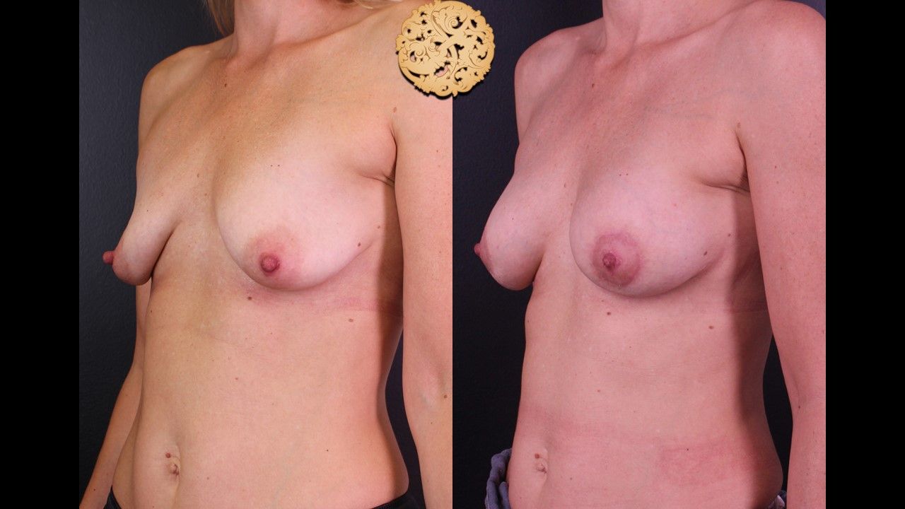 Breast Augmentation Before & After
