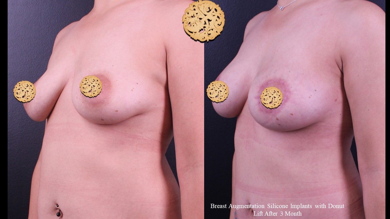 Breast Augmentation Before & After