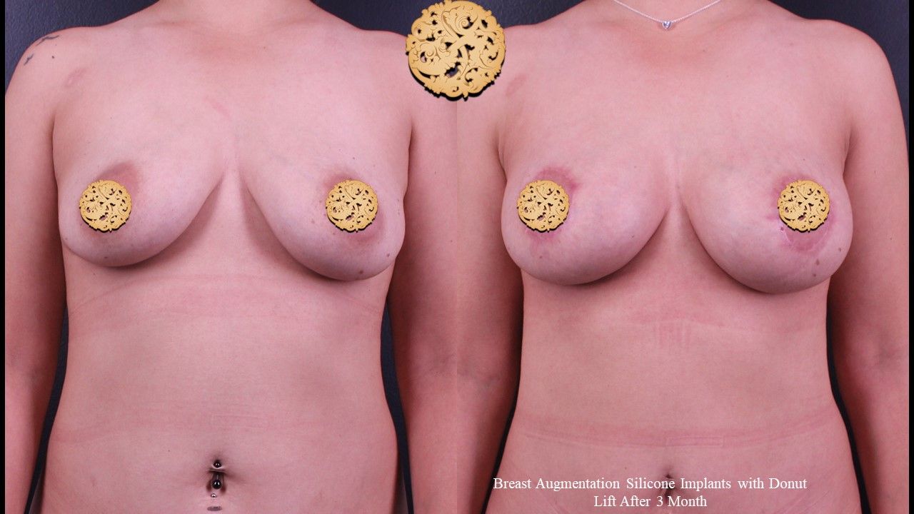 Breast Augmentation Before & After