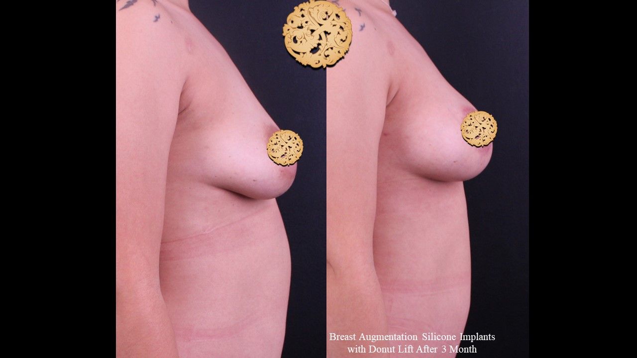 Breast Augmentation Before & After