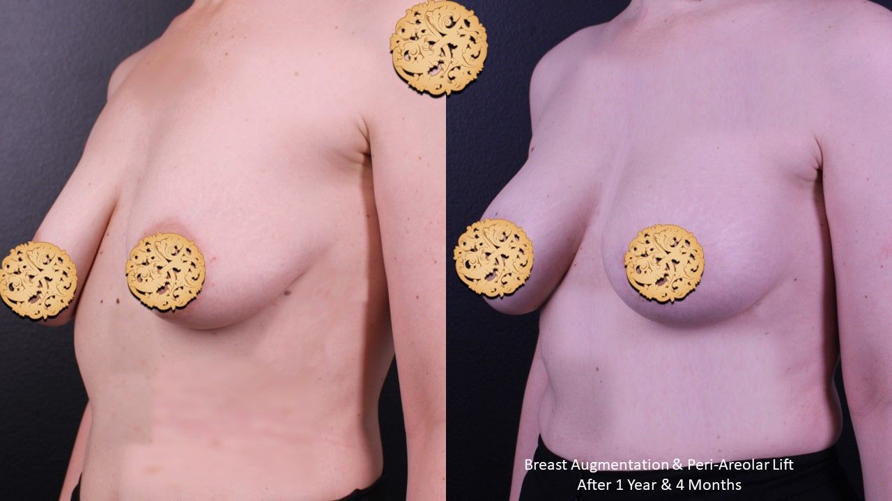 Breast Augmentation Before & After