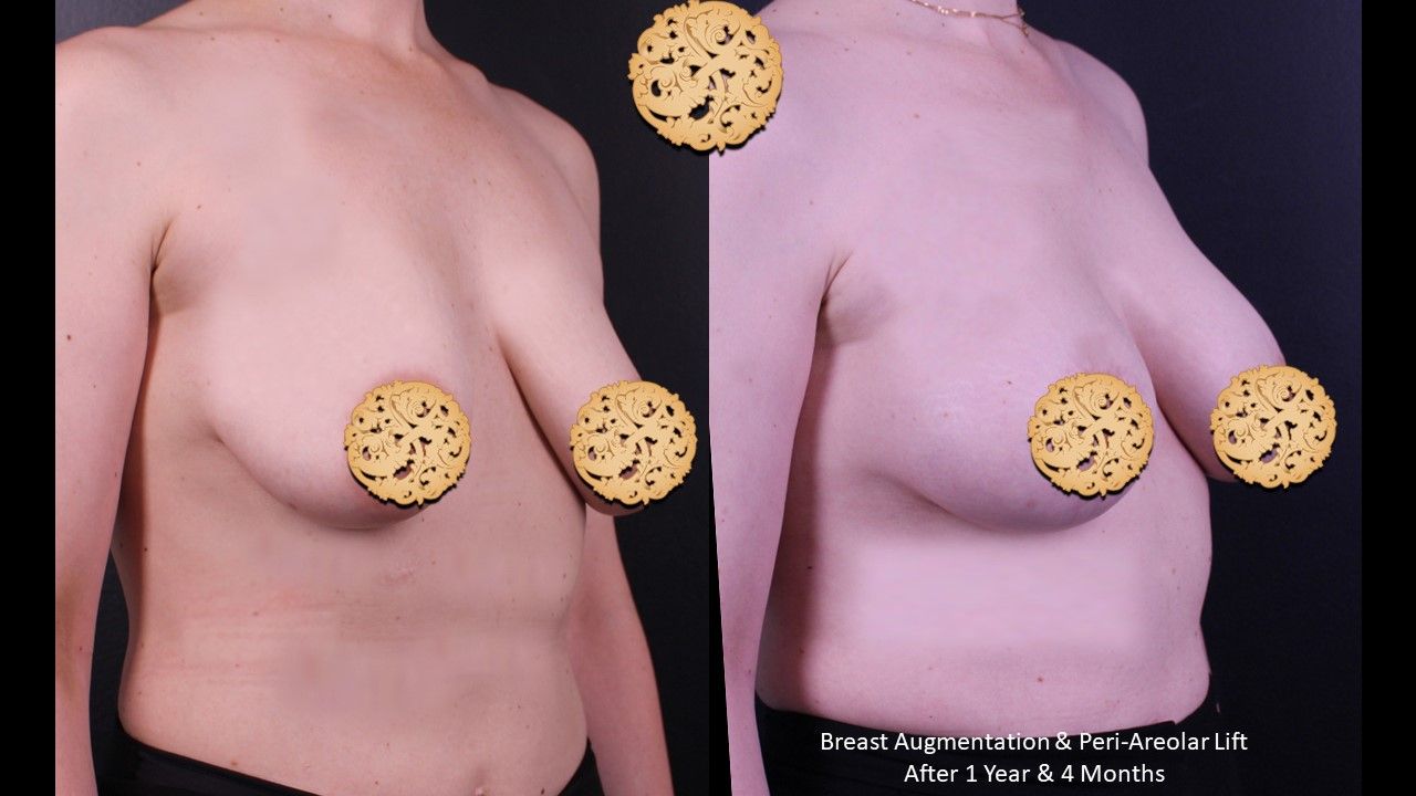 Breast Augmentation Before & After