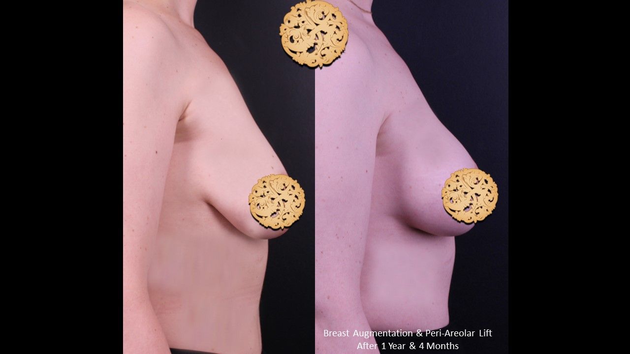 Breast Augmentation Before & After