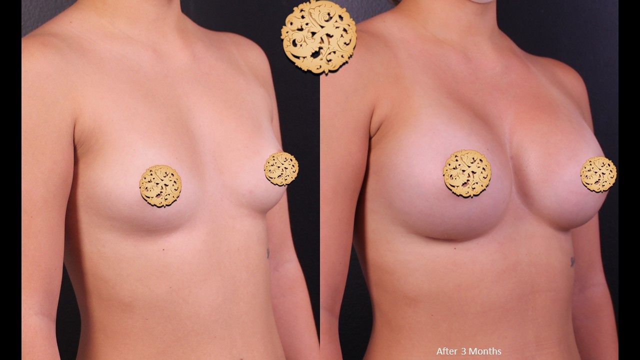 Breast Augmentation Before & After