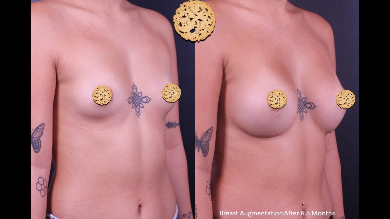 Breast Augmentation Before & After