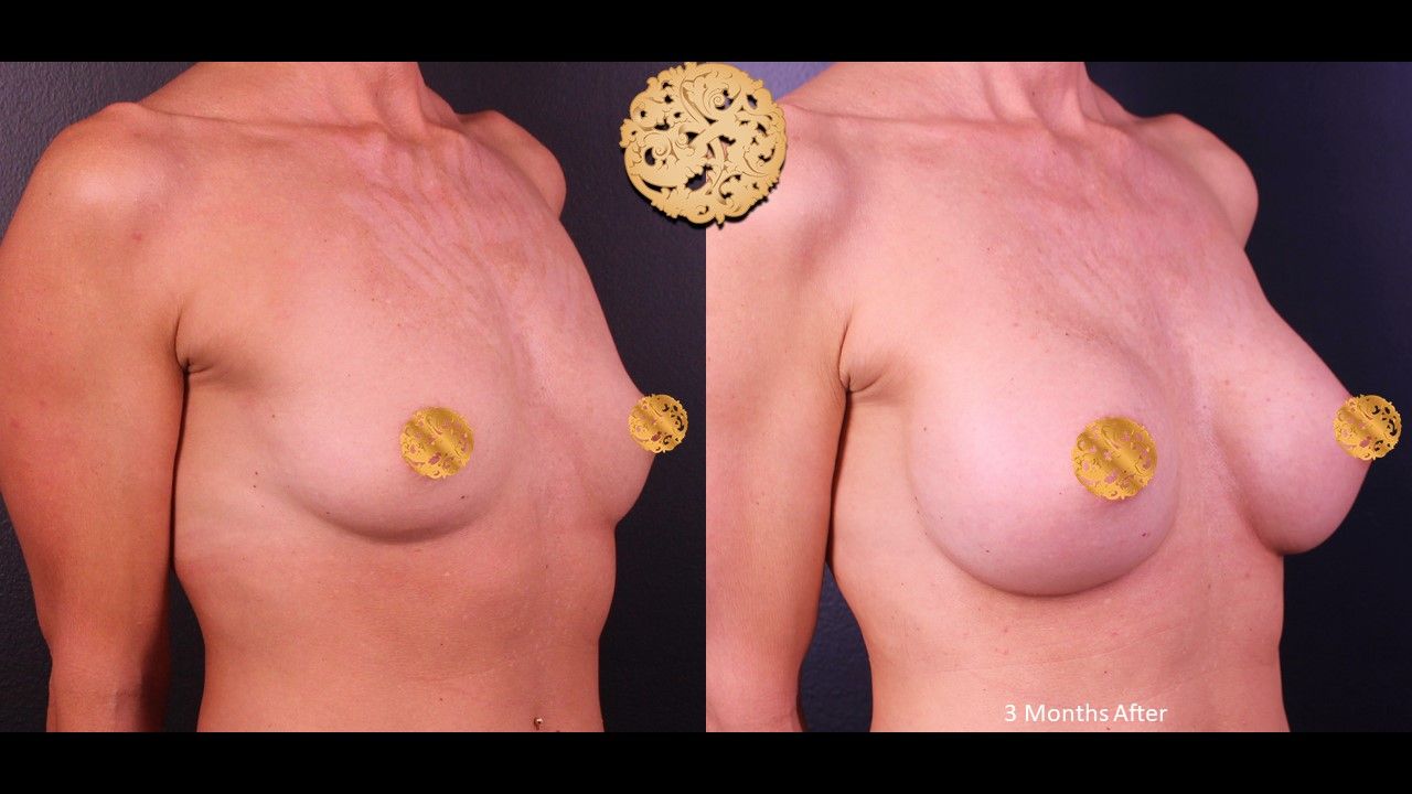 Breast Augmentation Before & After