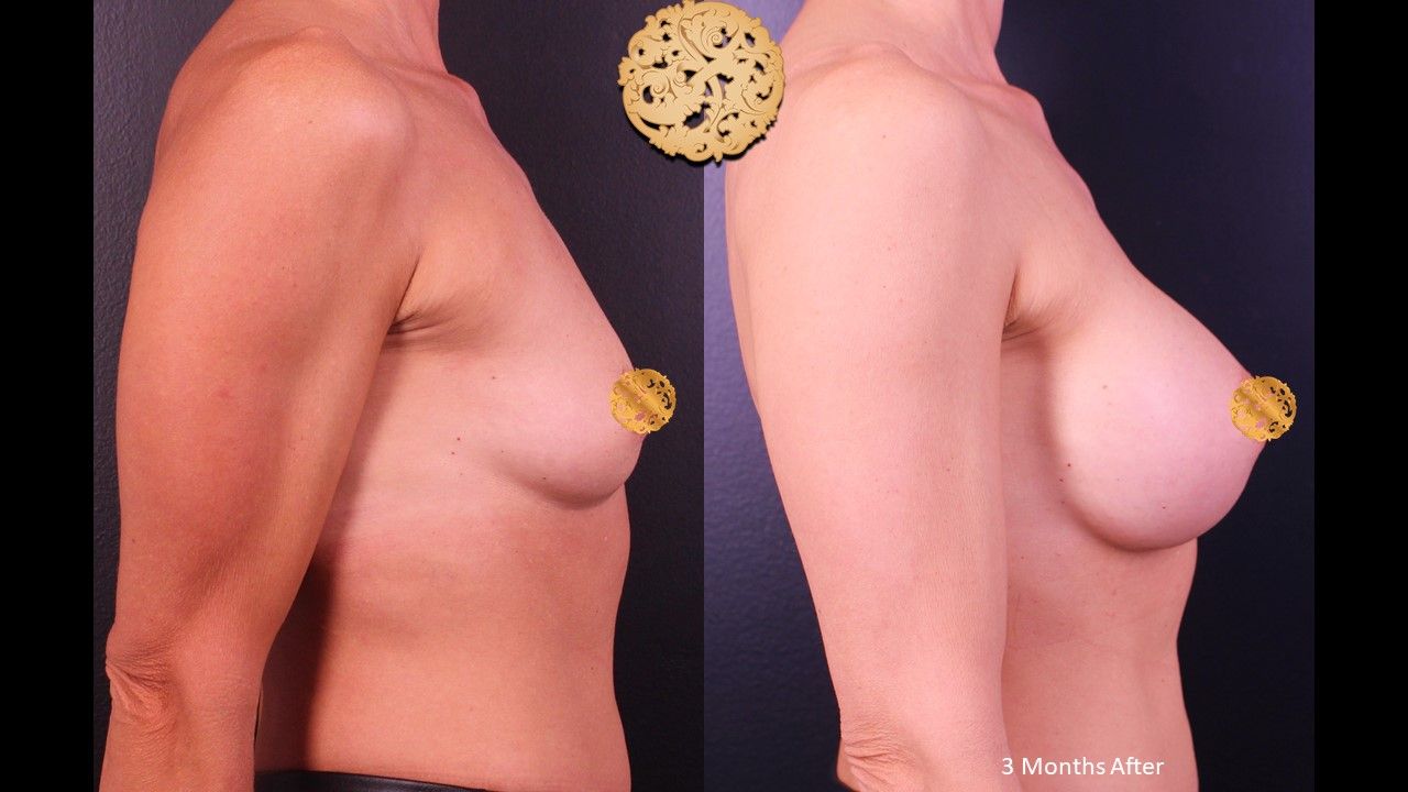 Breast Augmentation Before & After