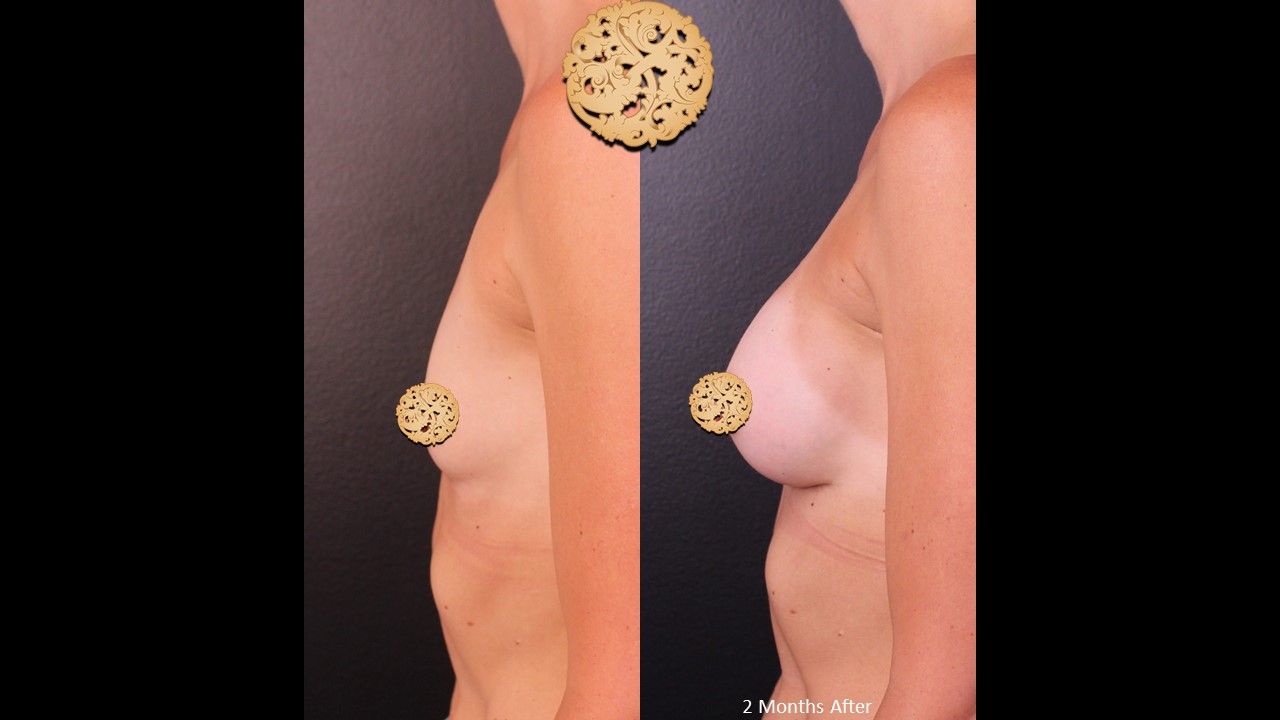 Breast Augmentation Before & After